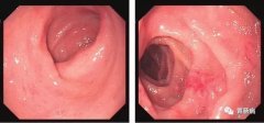 萎縮性胃炎不可怕，只要