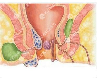 南寧哪個(gè)醫(yī)院可以做肛周膿腫?